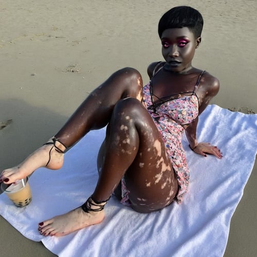 Vitiligo by Chesthole on Tensor.Art